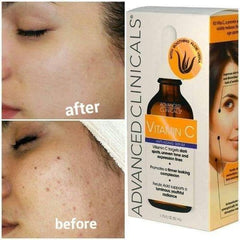 Advanced clinicals Vitamin C Anti-aging Serum For Dark Spots - 52ml