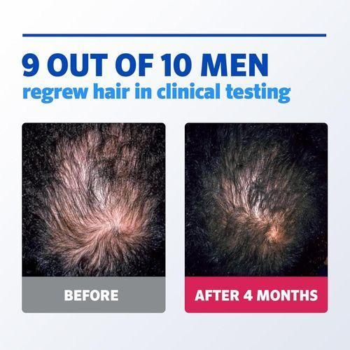 Rogaine Men's 5% Minoxidil Hair Regrowth Treatment Foam 3 Month Supply 3X60g
