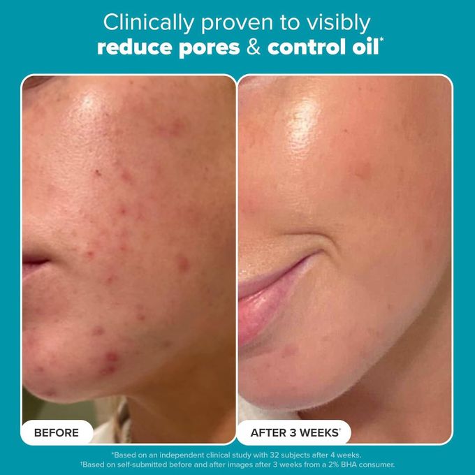 PAULA'S CHOICE Skin Perfecting 2% BHA Liquid Salicylic Acid Exfoliant 30 ml